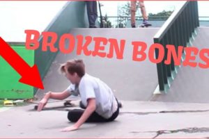 Skateboarding Fails Broken Bones Compilation April 2019