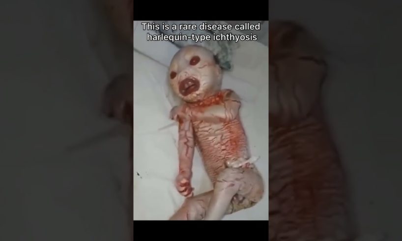 Rare disease you could have (Harlequin-type ichthyosis) #shorts