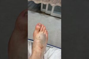 Poor Mathew #youtubeshorts #dirtbike #crash #shortsvideo #bike #hospital #motorcycle