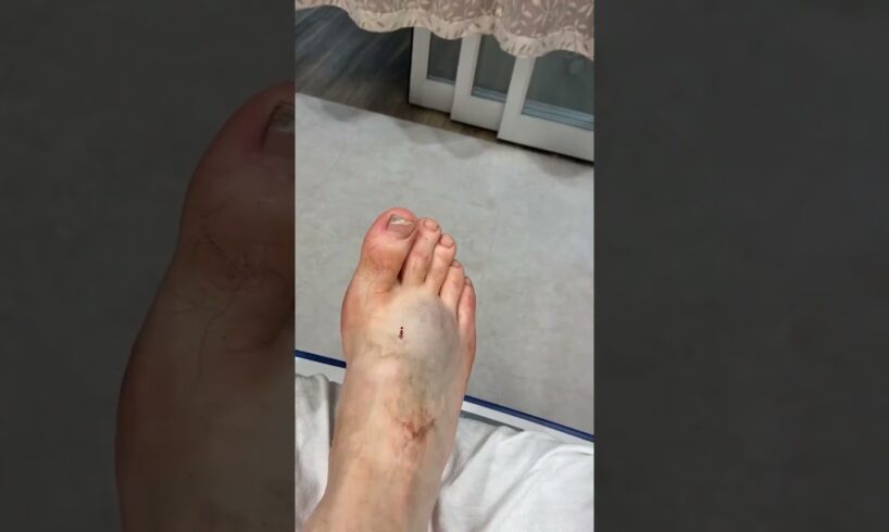 Poor Mathew #youtubeshorts #dirtbike #crash #shortsvideo #bike #hospital #motorcycle