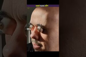 दुनिया के सबसे Rare इंसान एक अरब में एक 😱