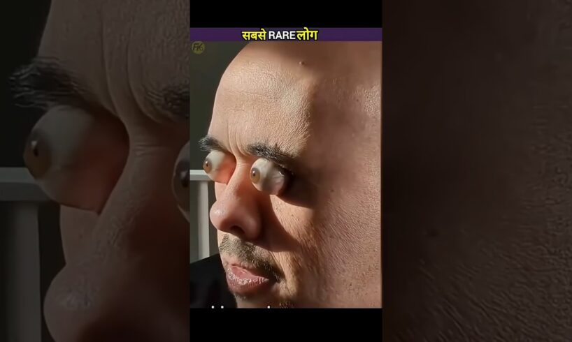 दुनिया के सबसे Rare इंसान एक अरब में एक 😱
